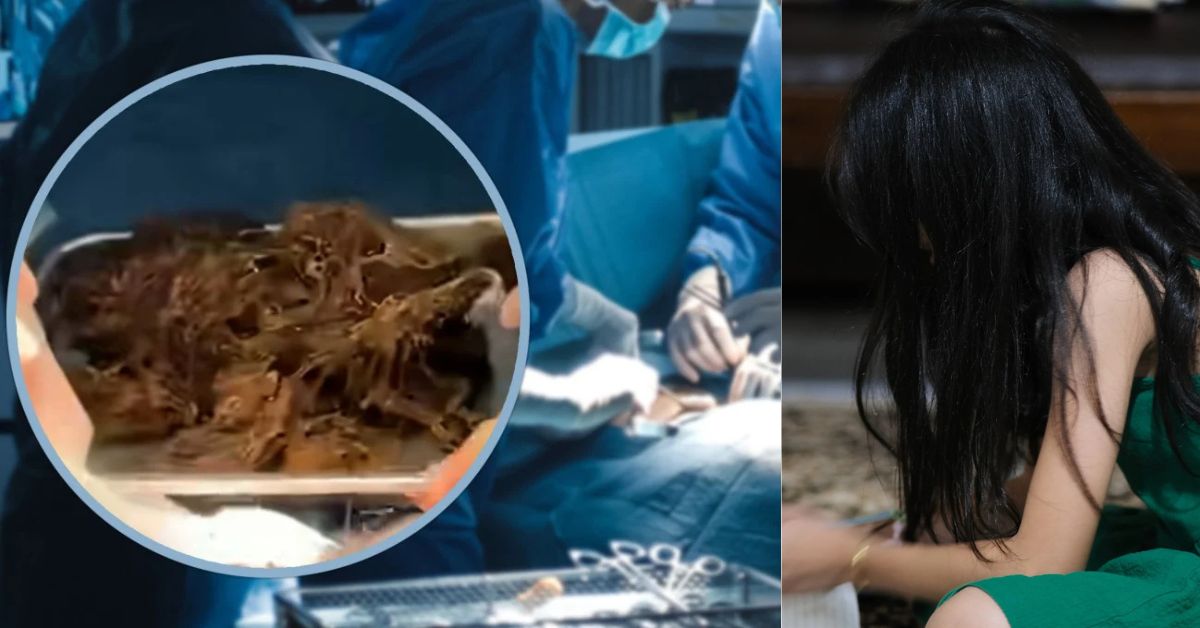 Trending chinese girl: ఆరేళ్లుగా జుట్టు తినే అలవాటు.. ప్రమాదంలో ప్రాణం.. తల్లిదండ్రులు నిర్లక్ష్యం!