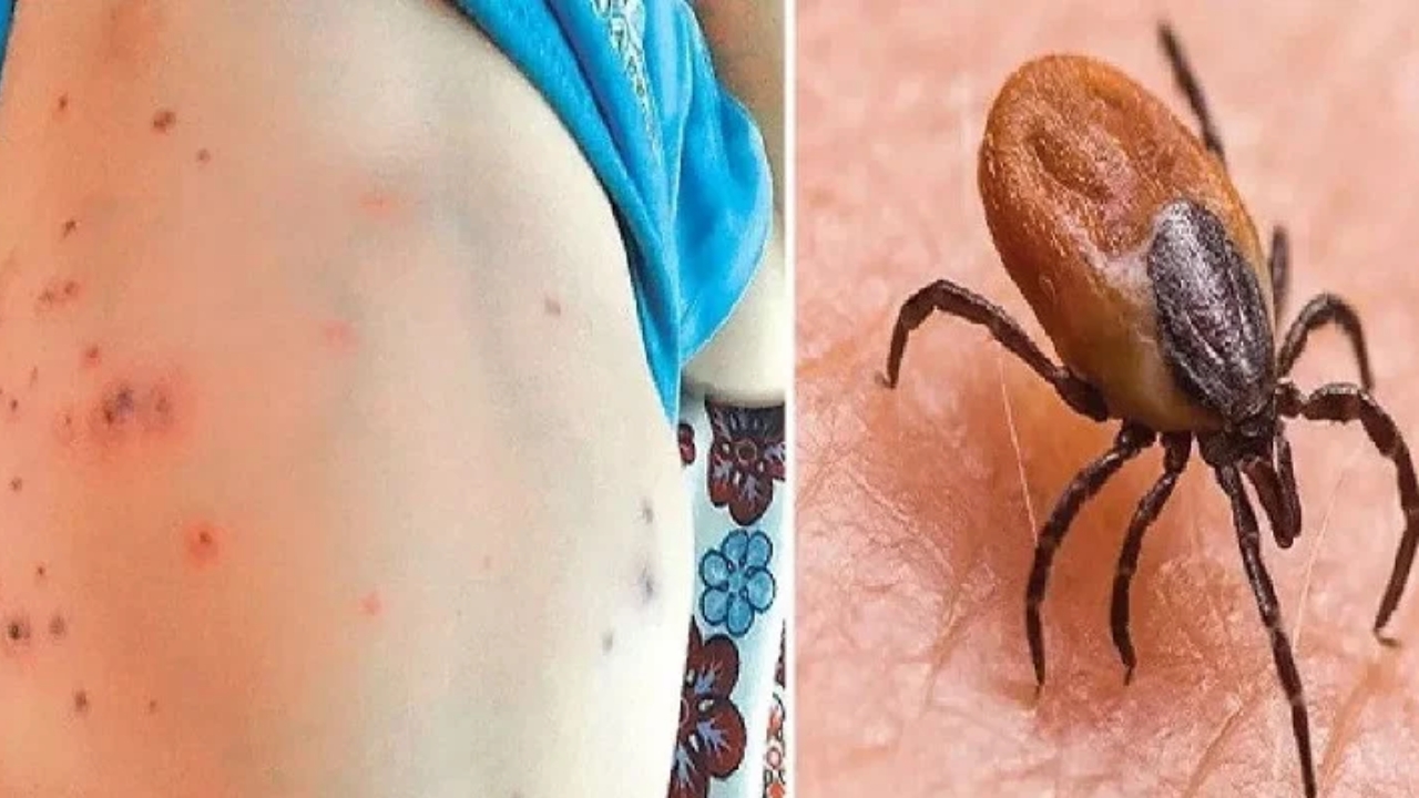 Scrub Typhus: ఏపీలో స్క్రబ్ టైఫస్ కలకలం.. 20 మంది మృతి!