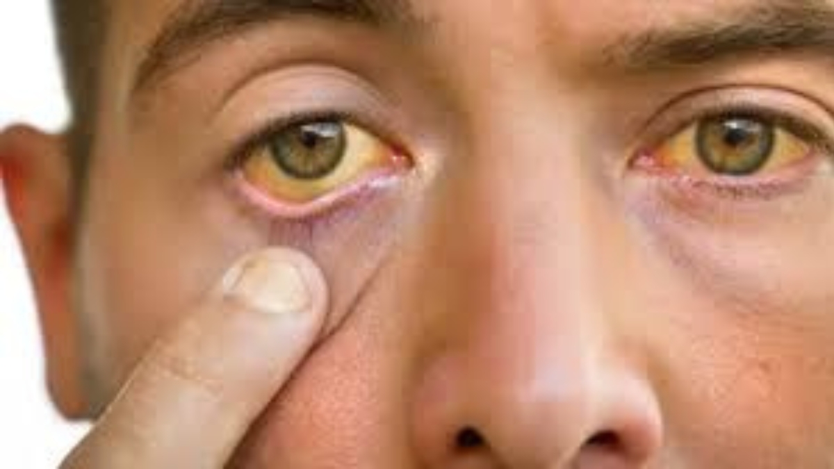 Yellow Eyes: కళ్లల్లో ఈ లక్షణాలు కనిపిస్తే ఒంట్లో ఆ పార్ట్ డ్యామేజ్‌ అయినట్లే!