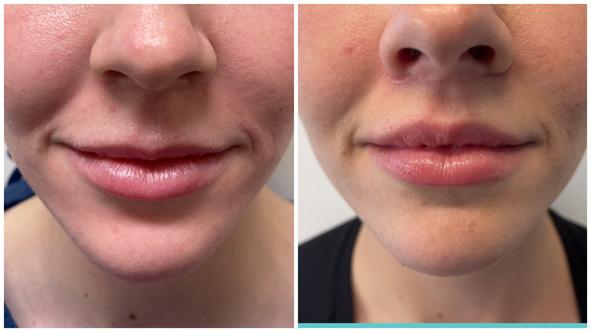 health tips human body: మీ ముఖంపై ఉండే ఈ రహస్య భాగం గురించి మీకు తెలుసా? ఫిల్ట్రమ్ అంటే ఏమిటి?