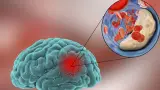 Health Tips: పక్షవాతానికి ముందు వచ్చే డేంజర్ బెల్స్.. మైక్రో స్ట్రోక్ పై వైద్యుల వివరణ!