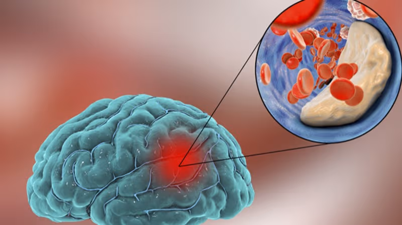 Health Tips: పక్షవాతానికి ముందు వచ్చే డేంజర్ బెల్స్.. మైక్రో స్ట్రోక్ పై వైద్యుల వివరణ!